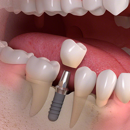 Implant borne single tooth treatment 03