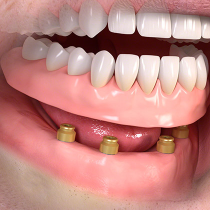 Removable denture with Lxxx attachement 03