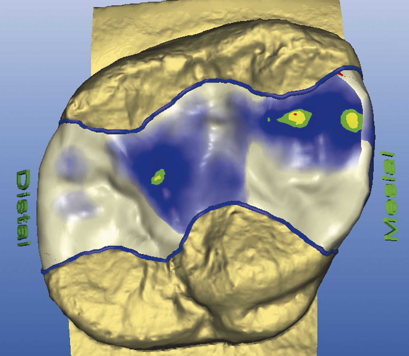 Cerec 3D Inlayrekonstruktion am Computer