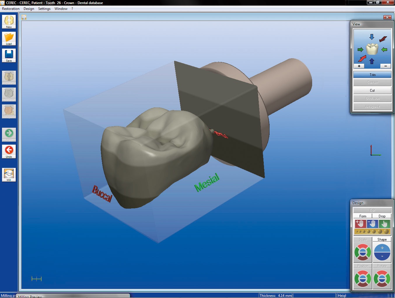 Cerec 3D Virtuelle Krone im Keramikblock