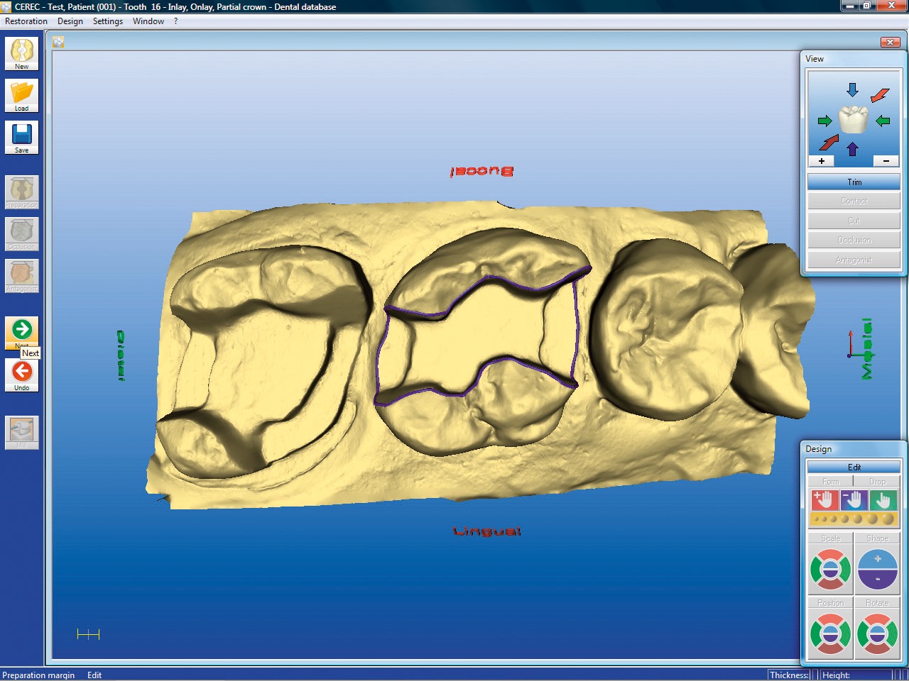 Cerec 3D gescannte Präparation auf PC-Monitor