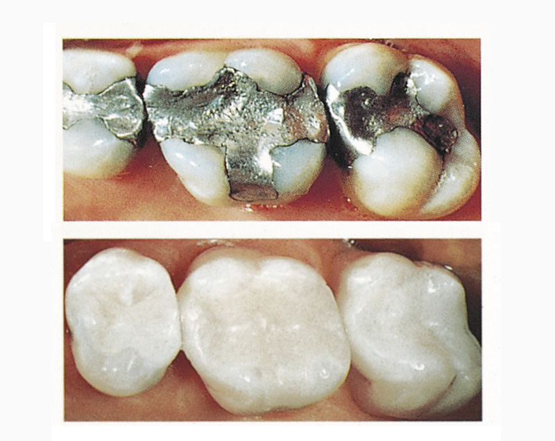 Cerec 3D Sog. Quadrantensanierung mit Keramikinlays und Onlays