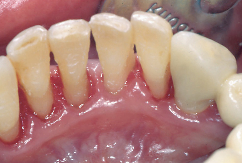 Zahnsituation nach der Professionellen Zahnreinigung