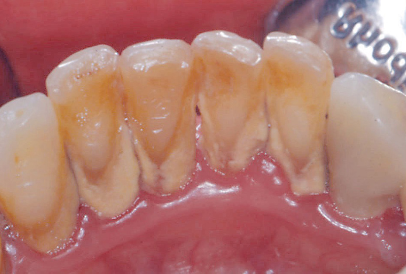 Zahnsituation vor der Professionellen Zahnreinigung 
